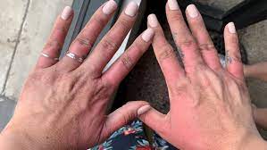 A rash appearing on the hands due to margarita burn;