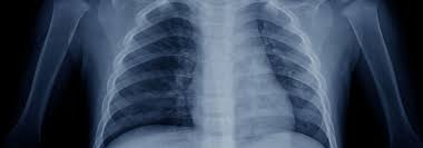 X-Ray image of White Lung Pneumonia around the lungs;